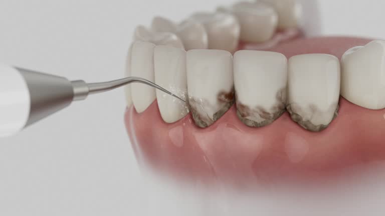 Trusted Dental Veneers service in Dodge City, KS - Dentist Open Now